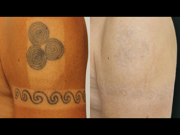 Professsionelle Laser-Tattooentfernung | UNIVERSIMED